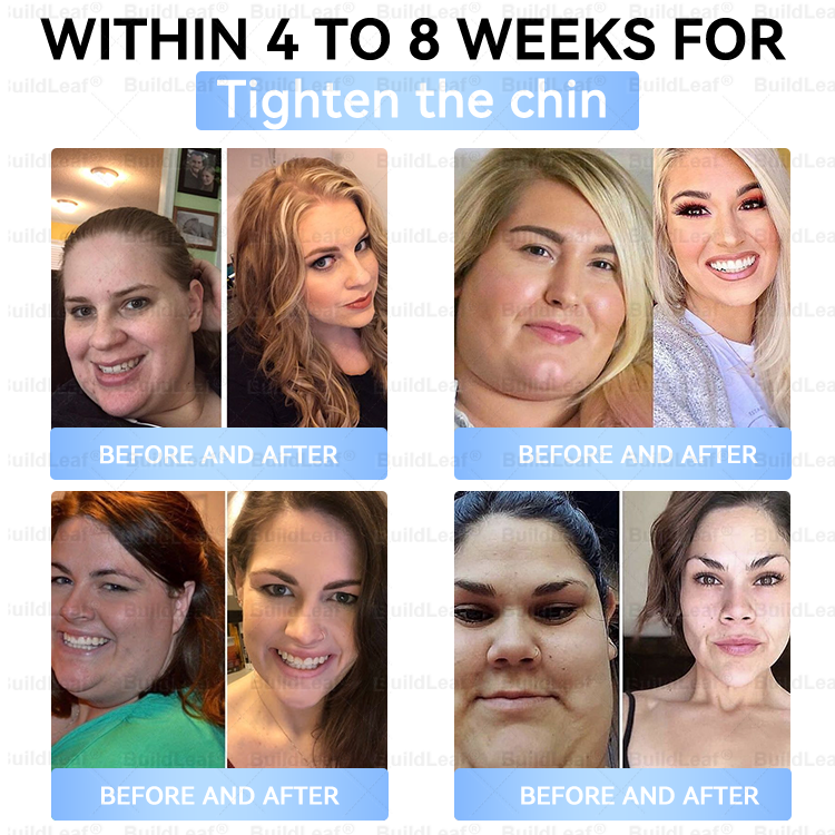 🏥𝑶𝒇𝒇𝒊𝒄𝒊𝒂𝒍 𝑺𝒕𝒐𝒓𝒆 |𝐵uil𝗱𝐿ea𝐟® 𝑮𝐋𝑃-1 Slim & Firm 𝑁ano 𝑀icroneedle 𝑃atch with Collagen,Turmeric&Matrixyl 3000 丨Obesity,Cardiovascular Diseas, Diabetes, Sleep Apnea, Joint Problems and More
