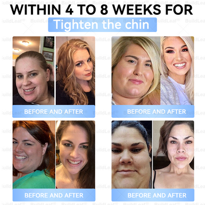 🏥𝑶𝒇𝒇𝒊𝒄𝒊𝒂𝒍 𝑺𝒕𝒐𝒓𝒆 |𝐵uil𝗱𝐿ea𝐟® 𝑮𝐋𝑃-1 Slim & Firm 𝑁ano 𝑀icroneedle 𝑃atch with Collagen,Turmeric&Matrixyl 3000 丨Obesity,Cardiovascular Diseas, Diabetes, Sleep Apnea, Joint Problems and More