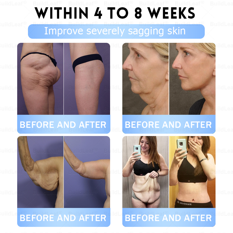🏥𝑶𝒇𝒇𝒊𝒄𝒊𝒂𝒍 𝑺𝒕𝒐𝒓𝒆 |𝐵uil𝗱𝐿ea𝐟® 𝑮𝐋𝑃-1 Slim & Firm 𝑁ano 𝑀icroneedle 𝑃atch with Collagen,Turmeric&Matrixyl 3000 丨Obesity,Cardiovascular Diseas, Diabetes, Sleep Apnea, Joint Problems and More