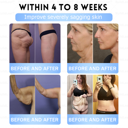 🏥𝑶𝒇𝒇𝒊𝒄𝒊𝒂𝒍 𝑺𝒕𝒐𝒓𝒆 |𝐵uil𝗱𝐿ea𝐟® 𝑮𝐋𝑃-1 Slim & Firm 𝑁ano 𝑀icroneedle 𝑃atch with Collagen,Turmeric&Matrixyl 3000 丨Obesity,Cardiovascular Diseas, Diabetes, Sleep Apnea, Joint Problems and More